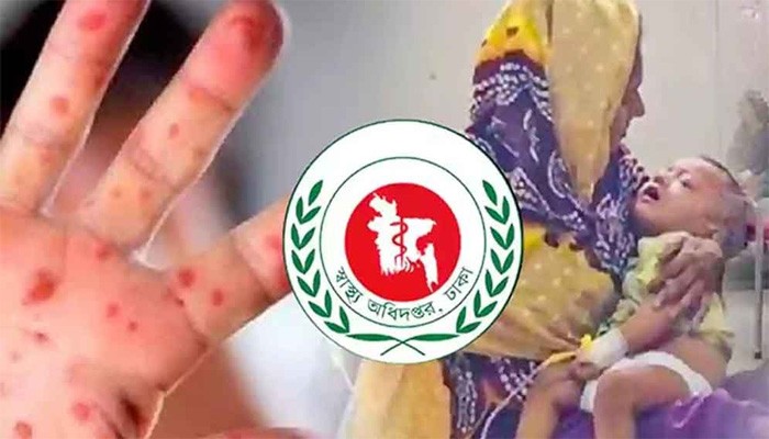 দেশে হাম উপসর্গে আরও ৫ শিশুর মৃত্যু