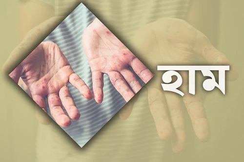 হাম উপসর্গে একদিনে ৩ জনের মৃত্যু